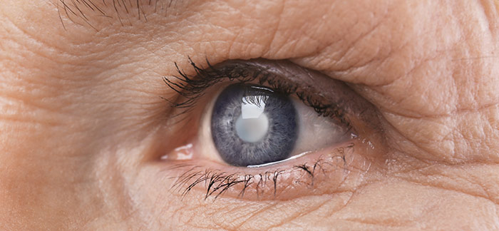 Cataracts - The main cause of impaired vision worldwide