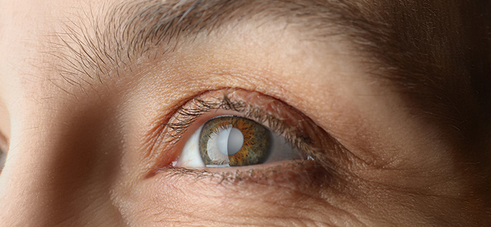 4 Fascinating Facts You Might Not Know About Cataracts