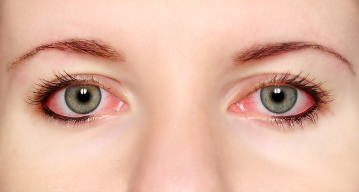 rubbing itchy eyes could lead to complications eye problems