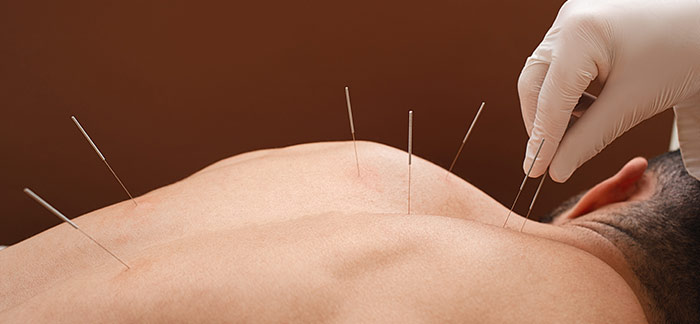 Acupuncture for Pain and Stress Management