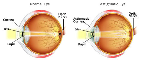 astigmatism eye faq advice problems lenses categories
